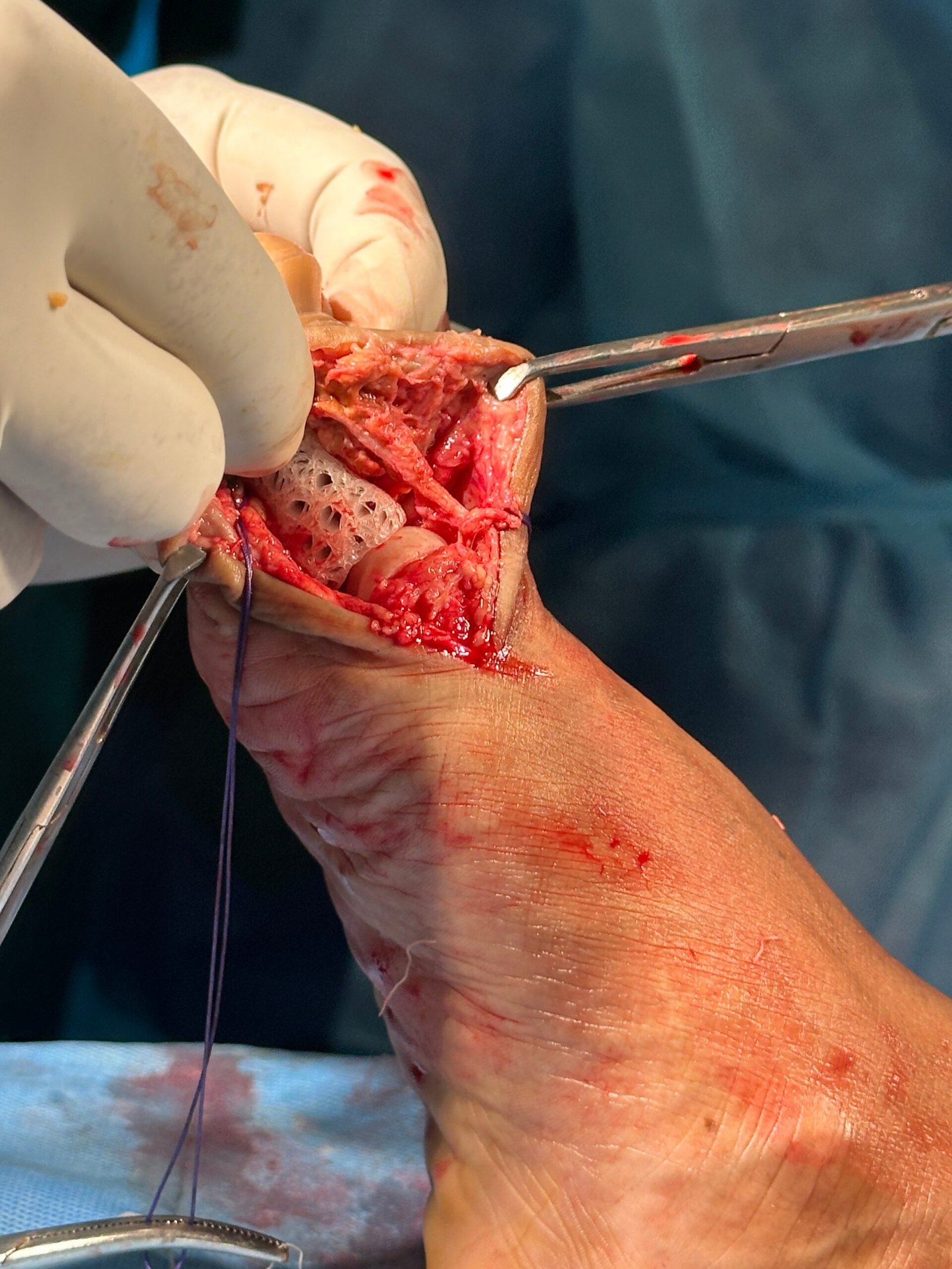 restor3d MyFit digital suite connecting orthopaedic patients and surgeons through personalized 3D-printed implant technology